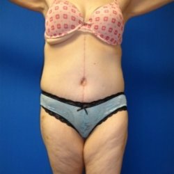 Manhattan abdominoplasty after 11